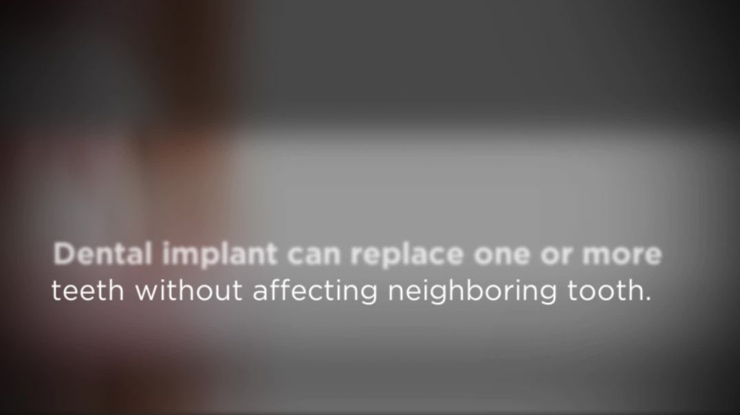 Artificial Roots to Support The Missing tooth