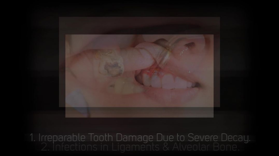 5 Reasons Why a Tooth Extraction is Necessary