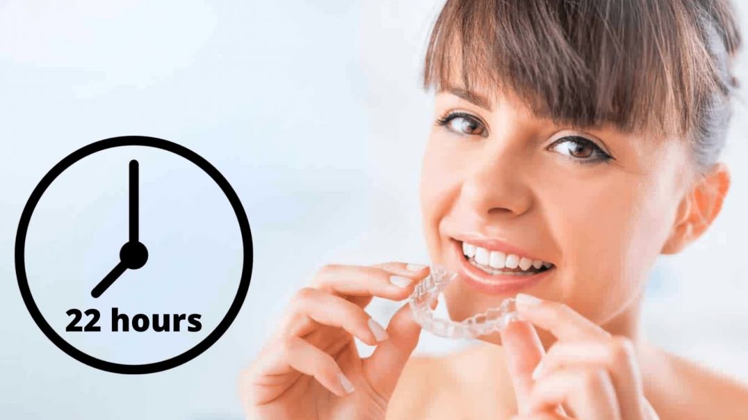 5 Things You Need to Know Before Starting Invisalign