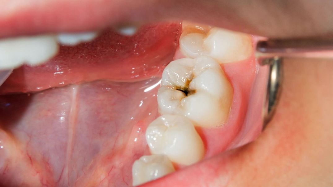 Maintain Your Natural Teeth for Lifetime