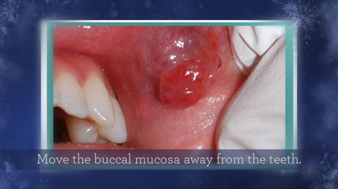 ⁣Mouth Cancer Process and its Importance