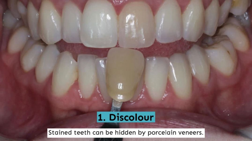 Shape Your Overall Appearance with Aesthetic Dentistry of Plantation