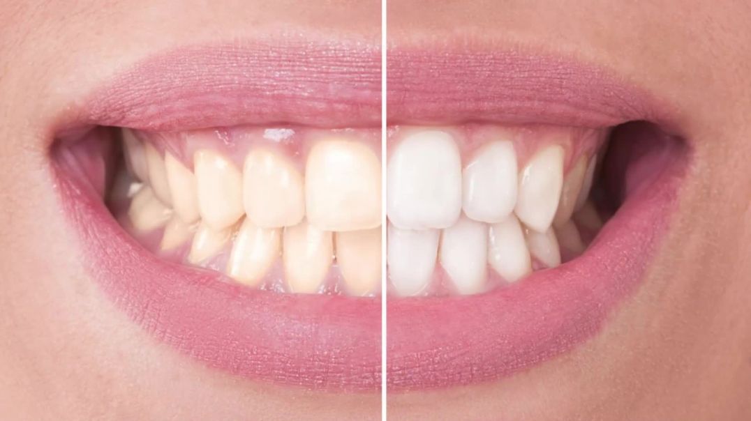 Get A Laser Teeth Whitening Treatment